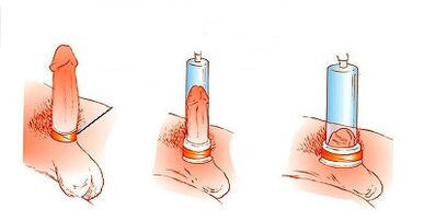 Le principe de fonctionnement de la pompe pour augmenter le pénis