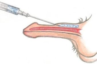 Une méthode dangereuse pour agrandir le pénis à l’aide d’injections de vaseline.